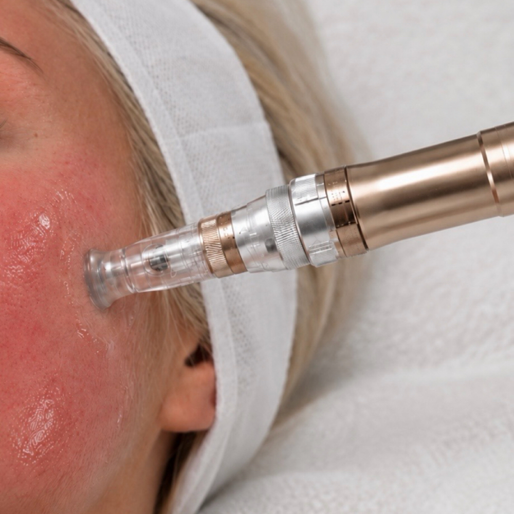 Microneedling Session at Nikki Rae Aesthetics in Scottsdale, AZ