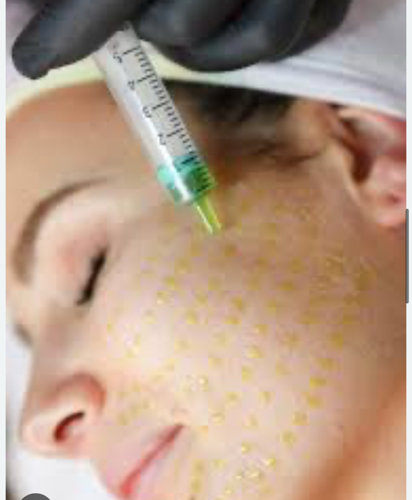 BiorePeel And Microneedling