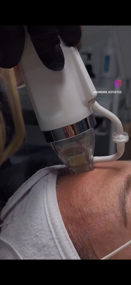 RF-Microneedling