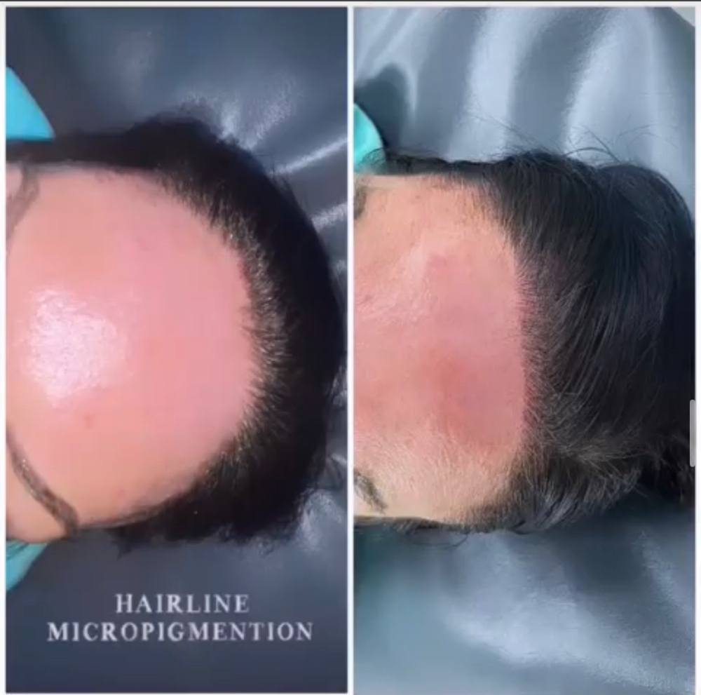 Micropigmentation Hairline💋