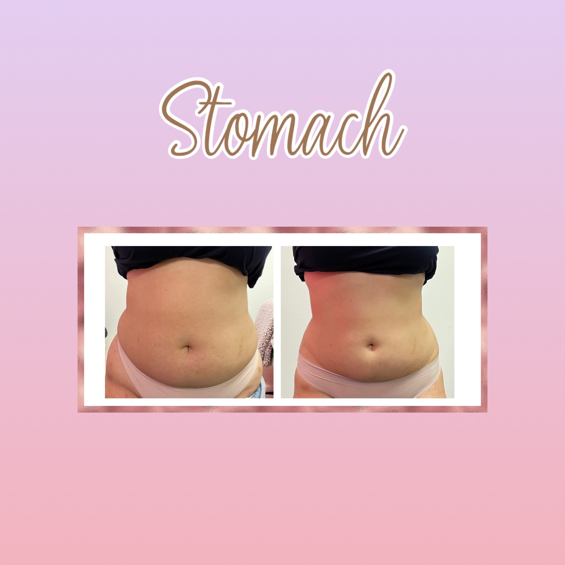 Stomach Sculpting