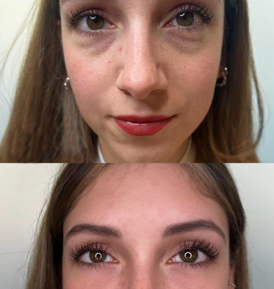 Relleno De Ojeras
