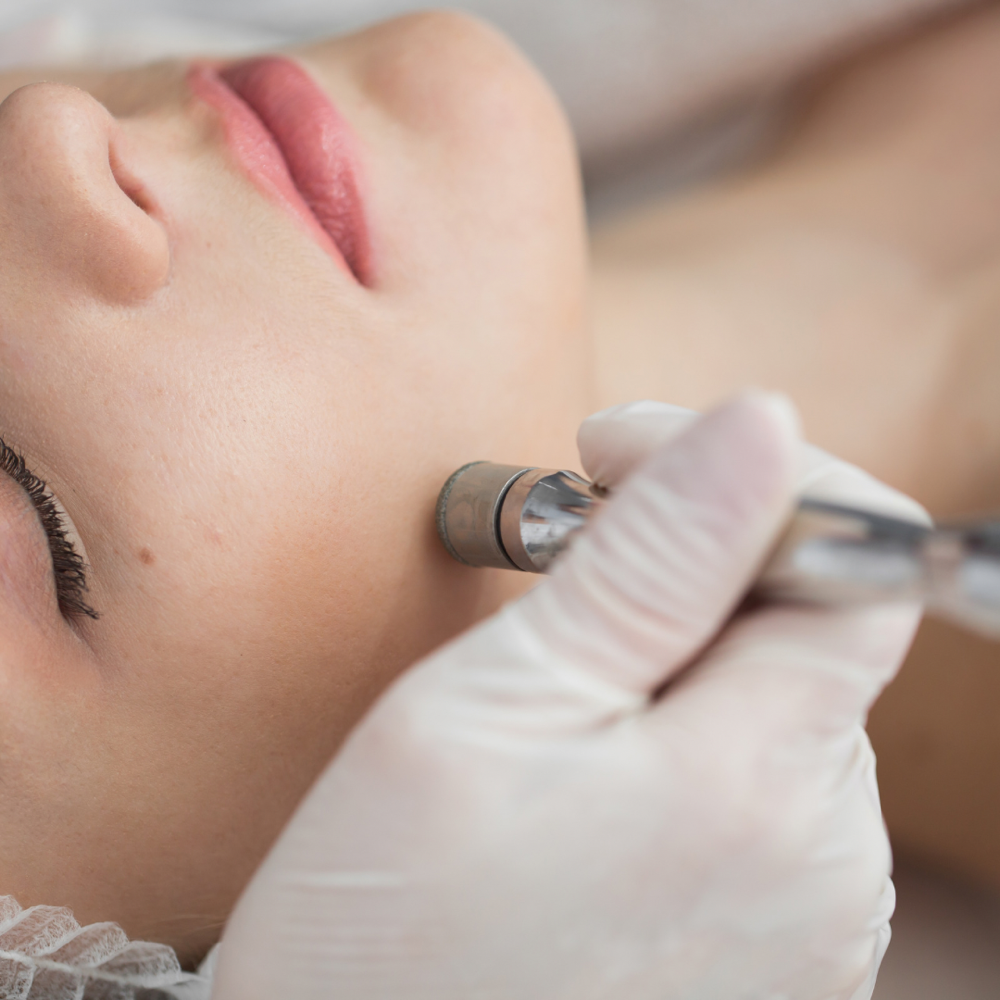 Microdermabrasion