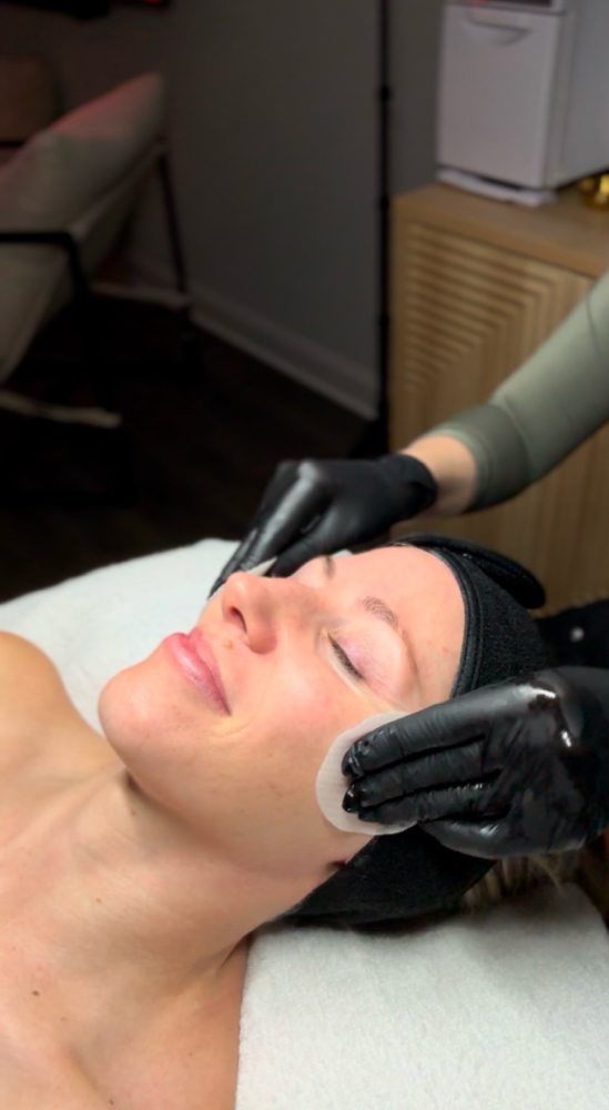 Chemical Peel Add-on
