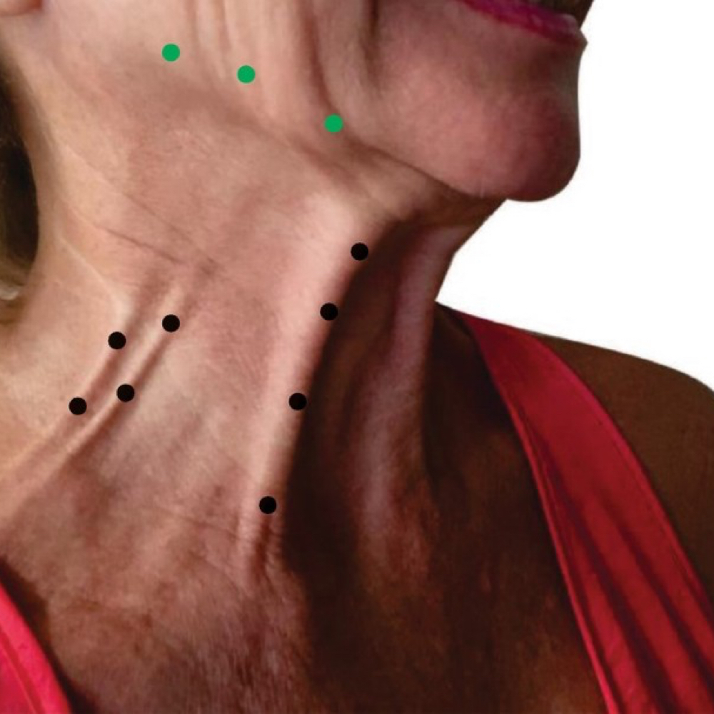 Platisma Botox at Kelly Sorza Beauty Esthetic in San Jose, CA