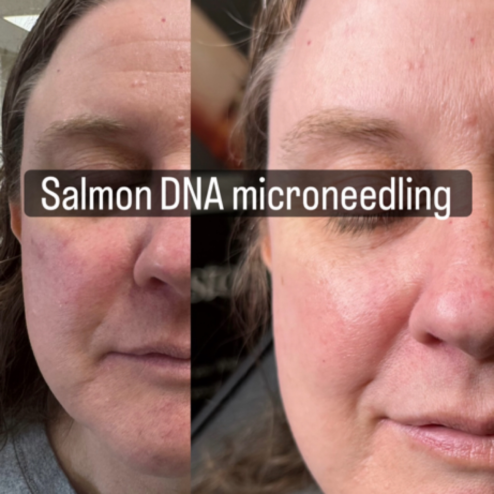 Salmon DNA Microneedling at Dvash Aesthetics in Lubbock, TX