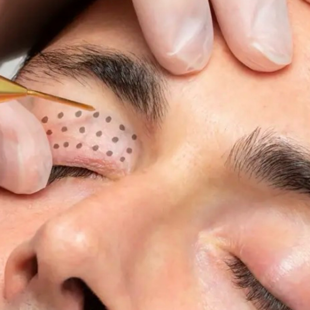 Plasma IQ Precision Renewal (F) at Empower Aesthetics in Canyon Lake, TX