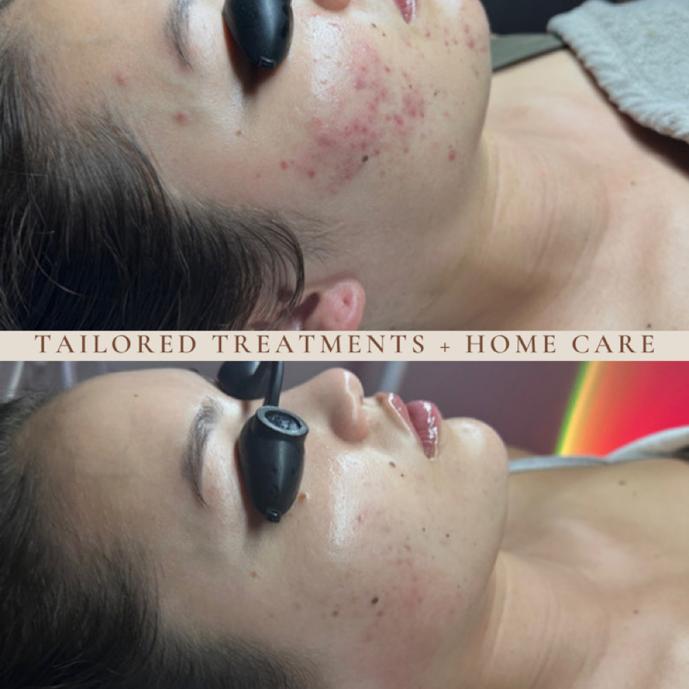 Acne Consultation + Treatment at Angelina Esthetics in Bakersfield, CA