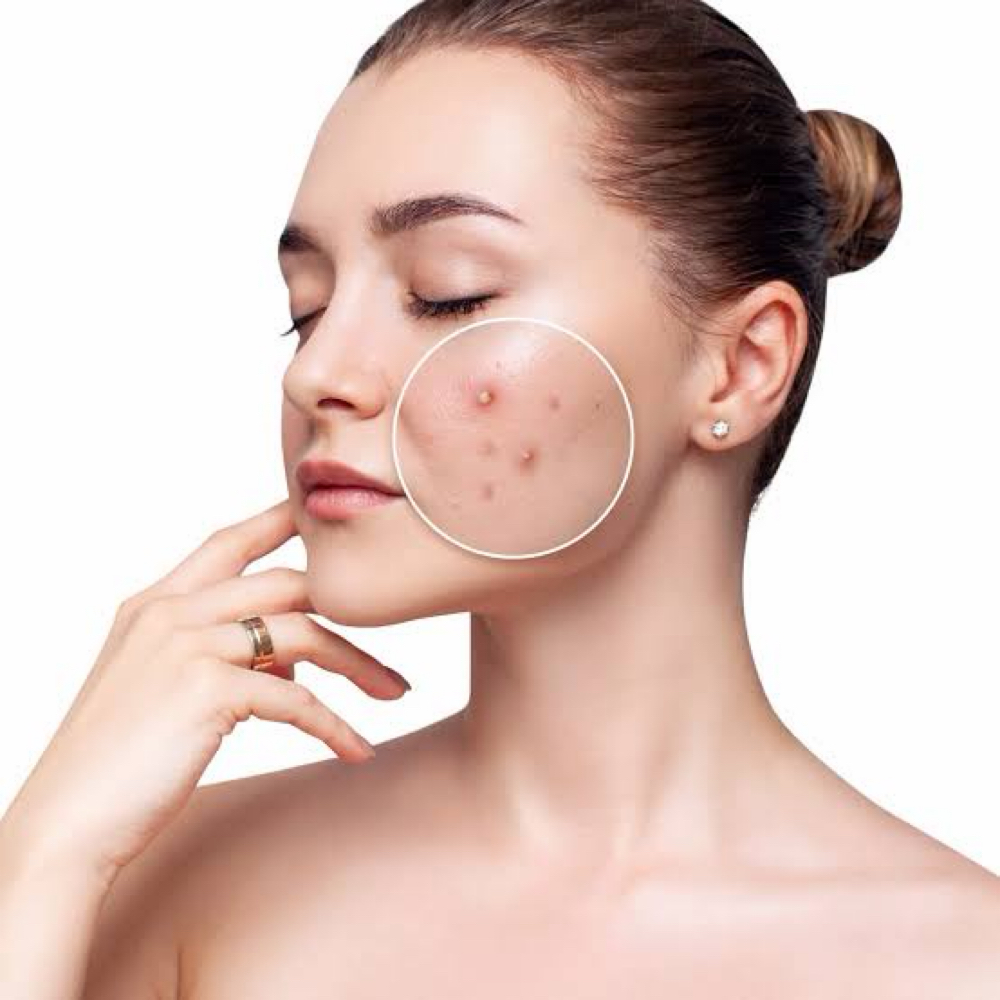 Acne Clearing Facial Adults at Haus of Beauty Studio in Hialeah, FL