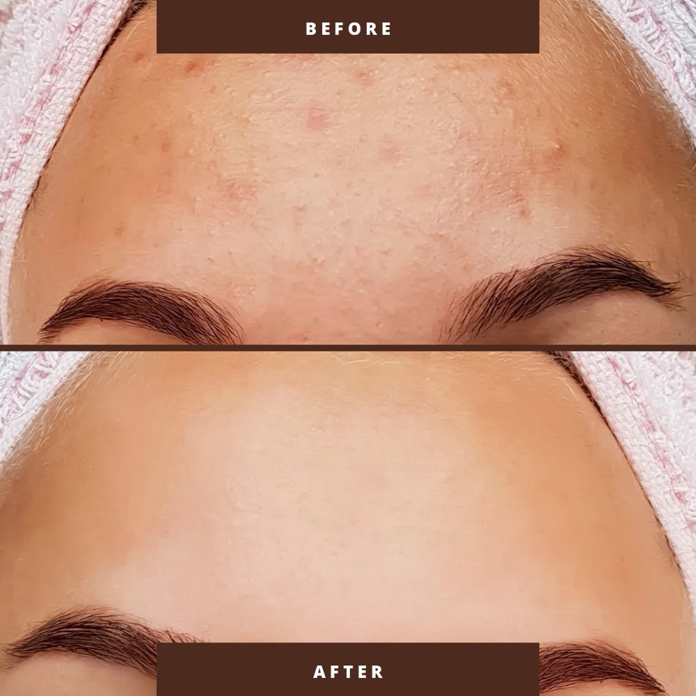 Acne Control Facial (Package Of 3 )