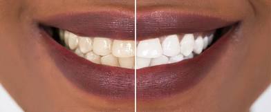Crystal Smile Activation