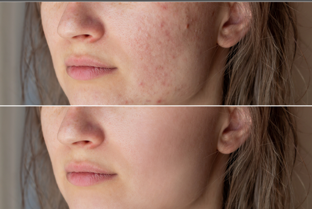Acne Facial