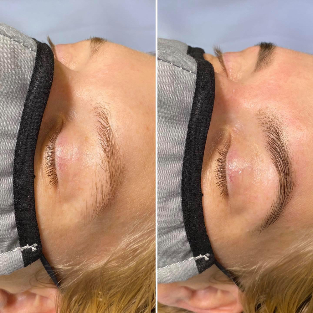 Brow transformation