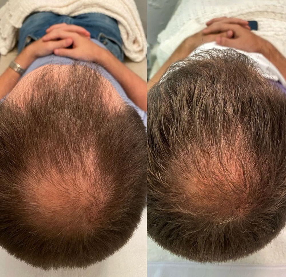 JetPeel Hair Restoration Series/6