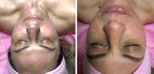 Ice Glow Facial
