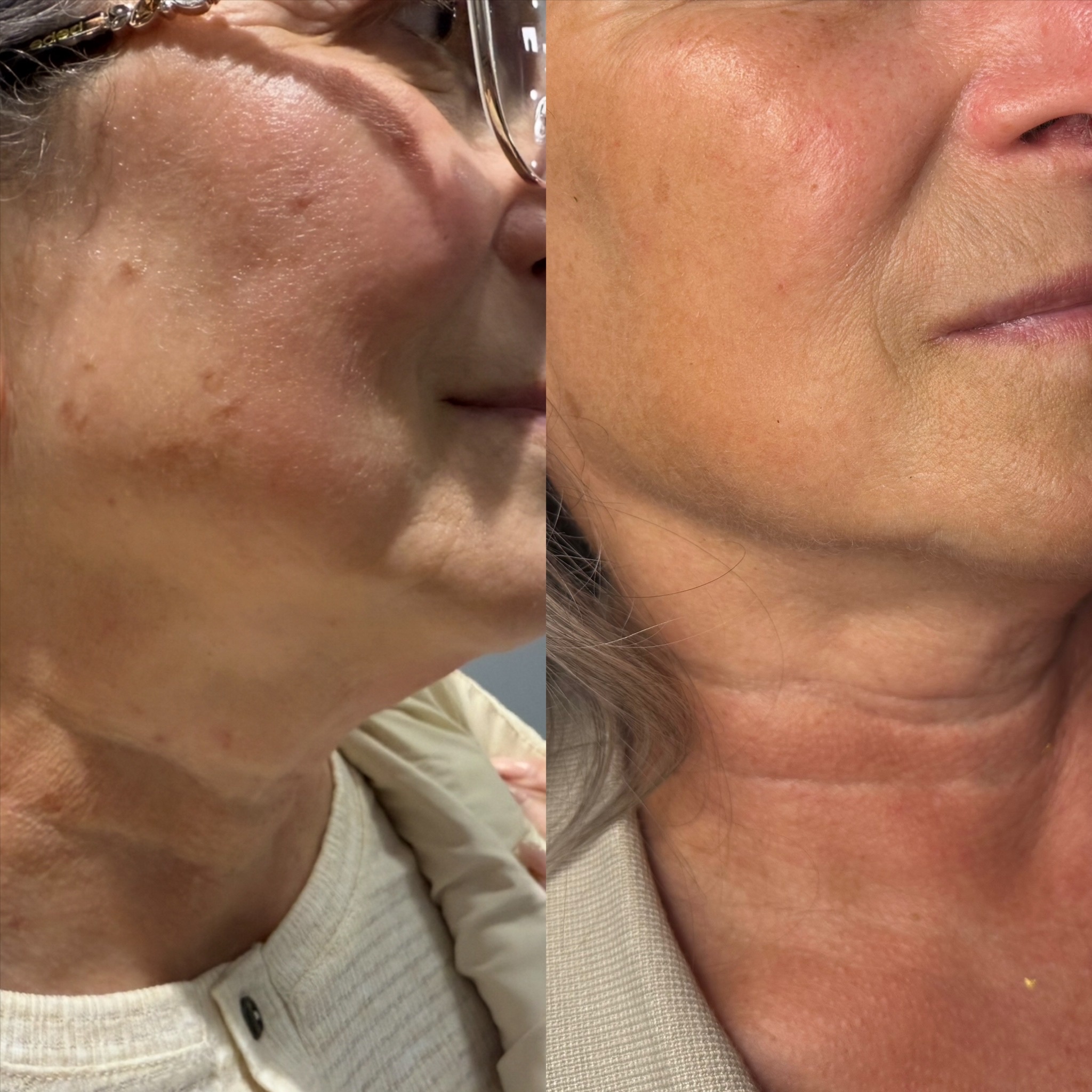 HIFU Face & Neck Skin Tightening at ForeverBeauty LLC in Leesburg, VA