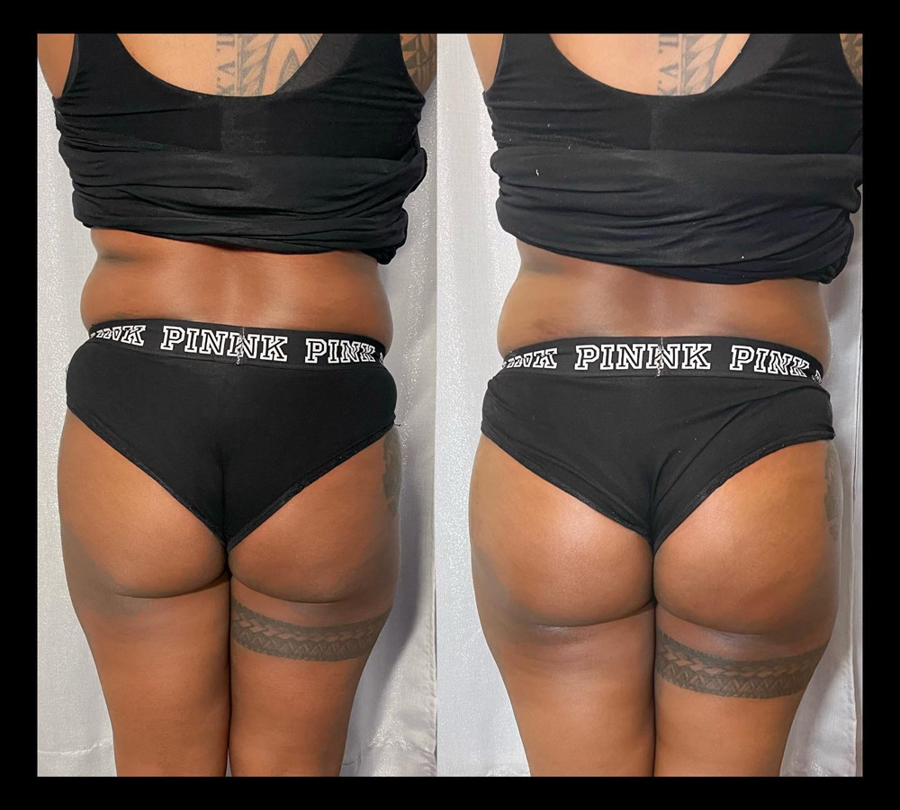 Nonsurgical BBL