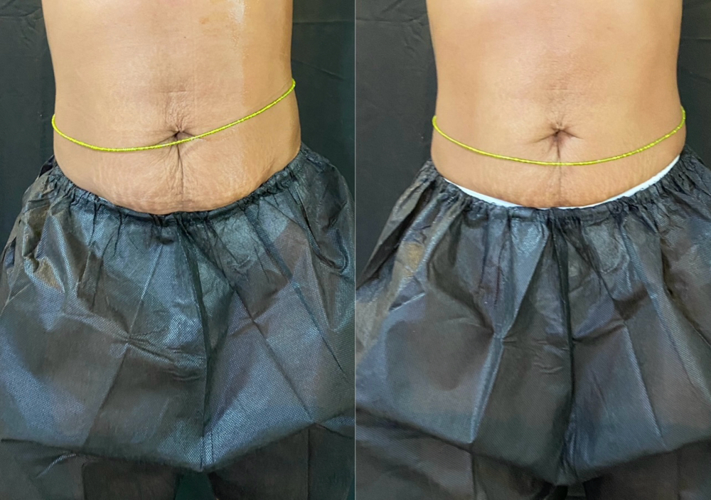 Radio Frequency Skin Tightening