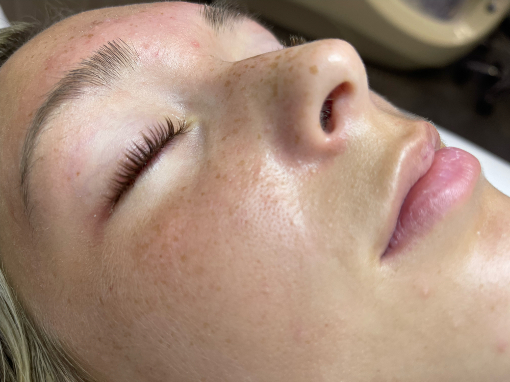 Hyaluronic Facial