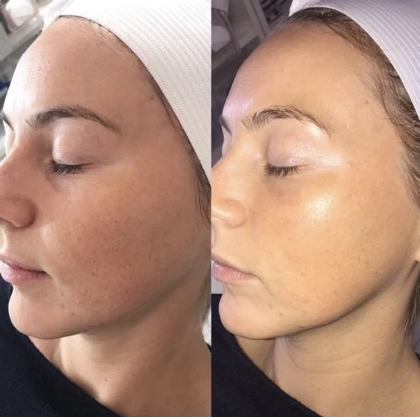 Dermaplane + Enzyme Peel Only