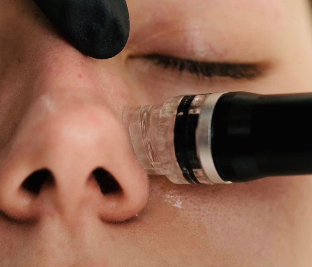 Hydrodermabrasion Facial