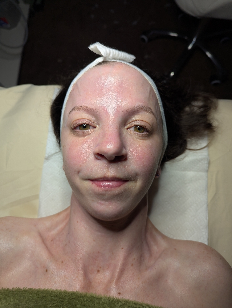 Microdermabrasion Facial