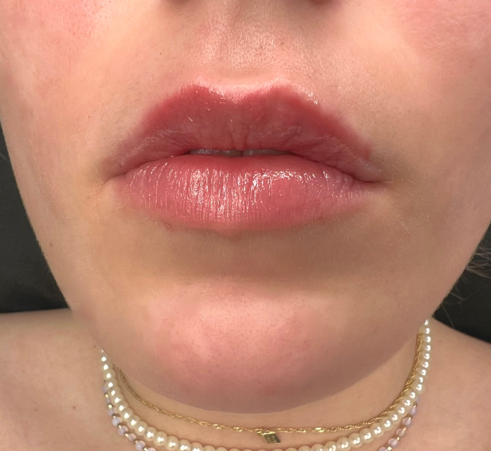 Lip Filler - 1ml