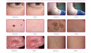 Skin Sheek Treatment