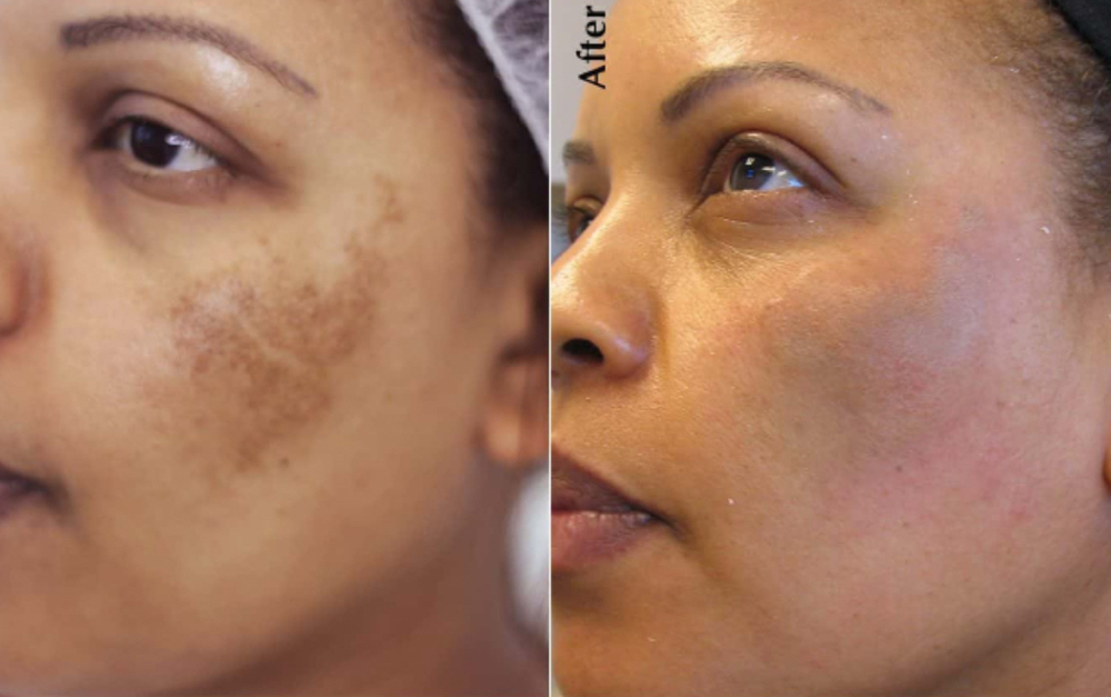 MicroPigment Scar Camoflage at Signature Skin Spa in Scottsdale, AZ
