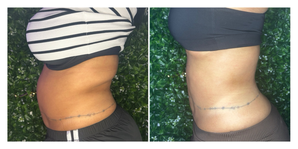 6 Session Special‼️ at Mia Mia Body Contouring in Harrisburg, PA