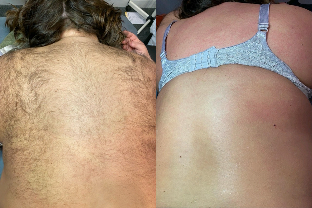 Back Wax at FACED AESTHETICS in Riverdale, GA