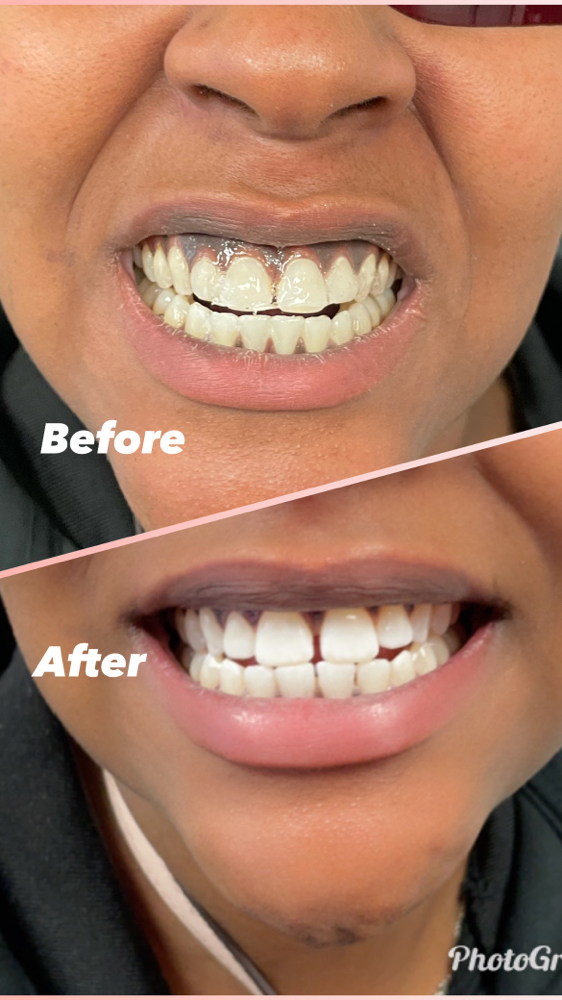 Teeth Whitening
