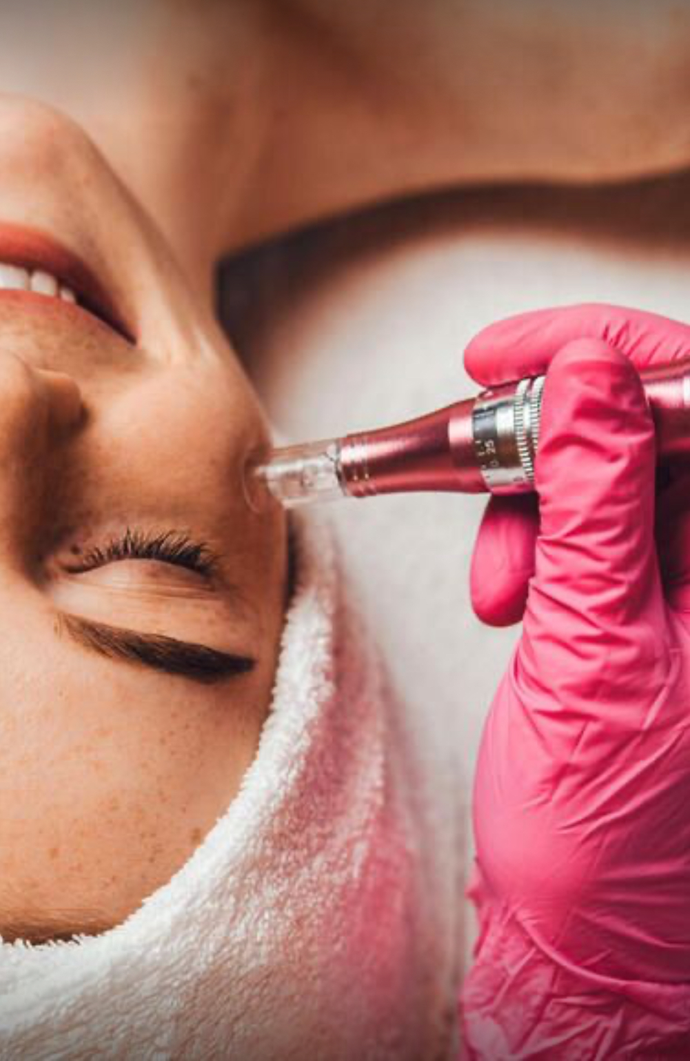 Microneedling
