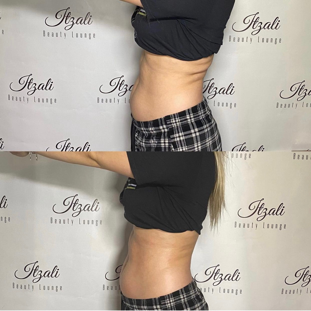 Lipo Cavitaton Trial