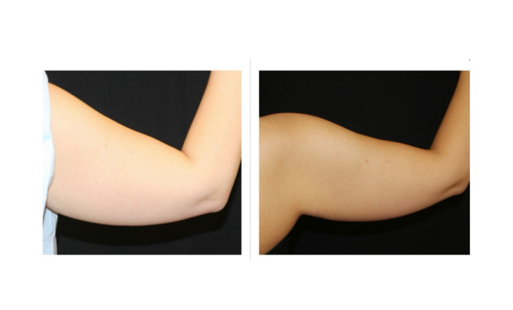 Non-Surgical Arm Fat Removal