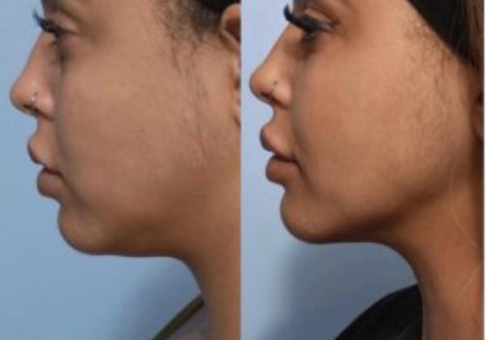 Double Chin Removal 1 session