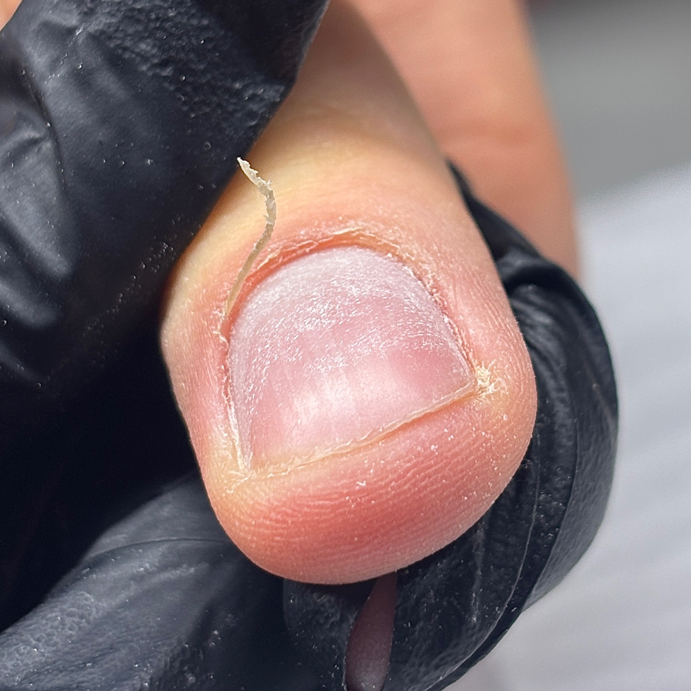Cuticle Cut