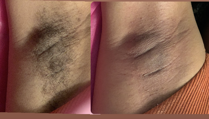 Underarm