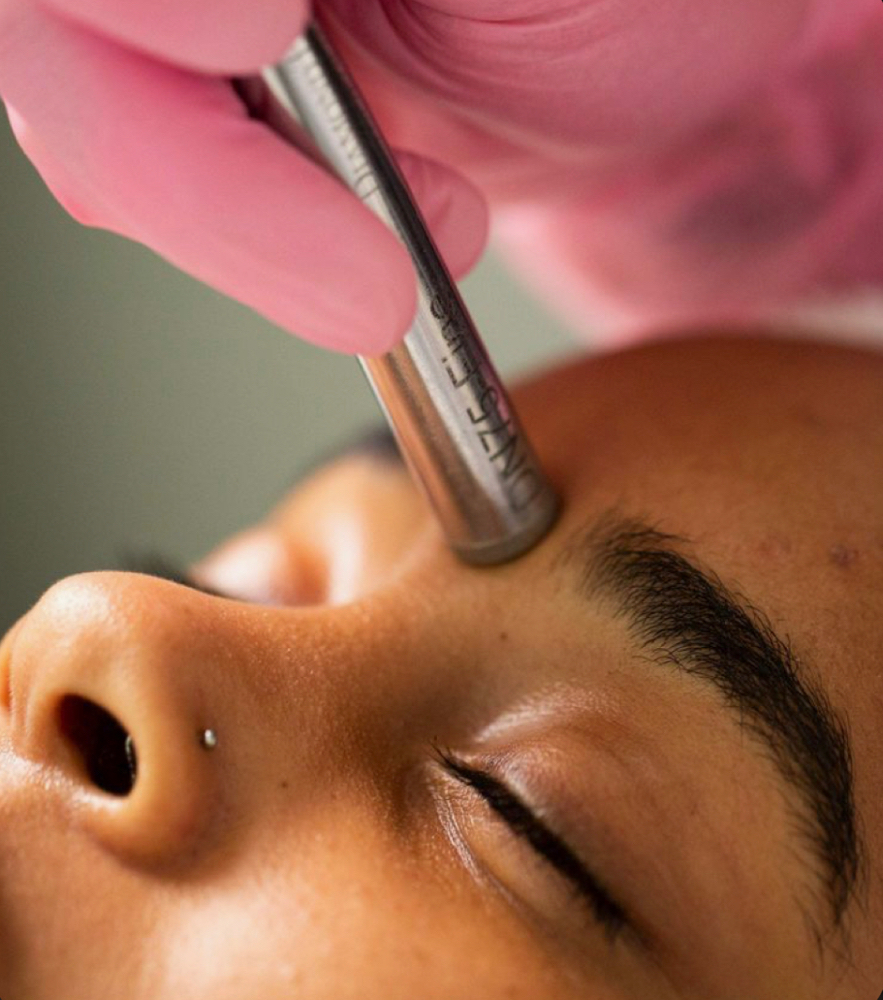 Microdermabrasion Facial