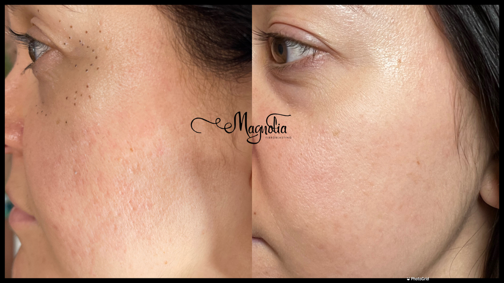 Acne Scar Treatment (each  Cheek)