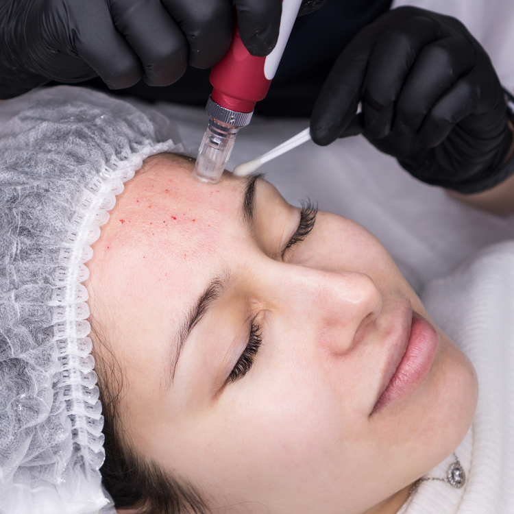 Microneedling