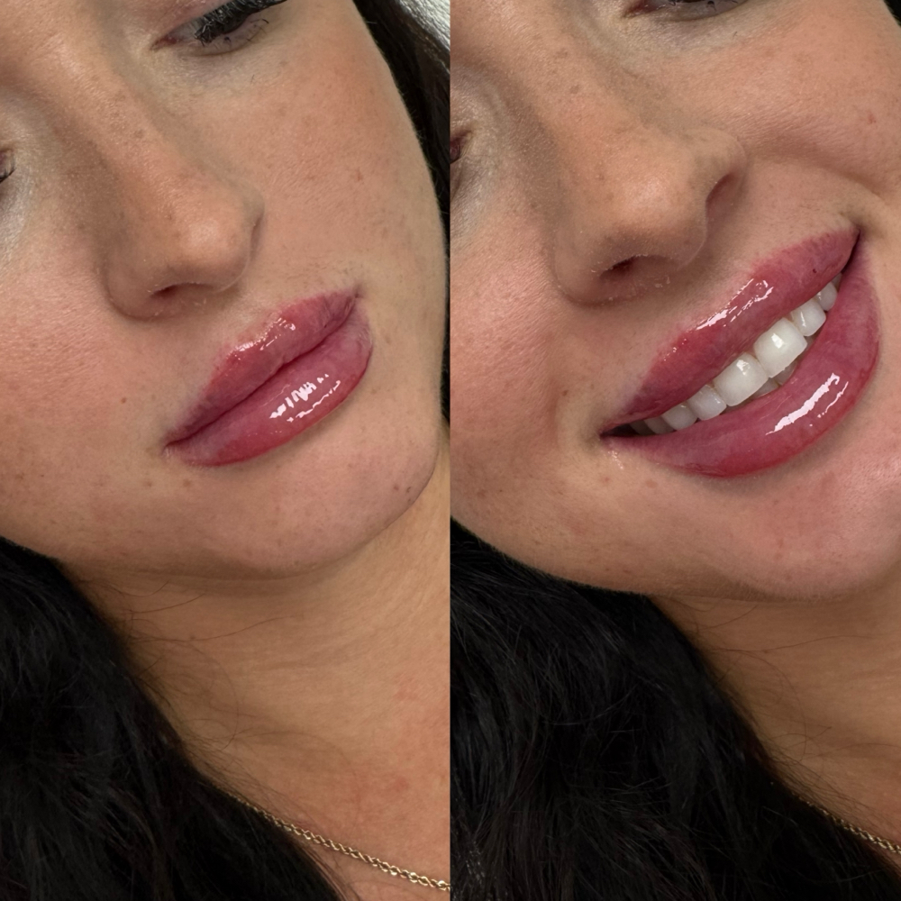 Buy 1 Get 1 (Bestie) at Aesthetic Beauty Bar, LLC By Haley in Tyler, TX