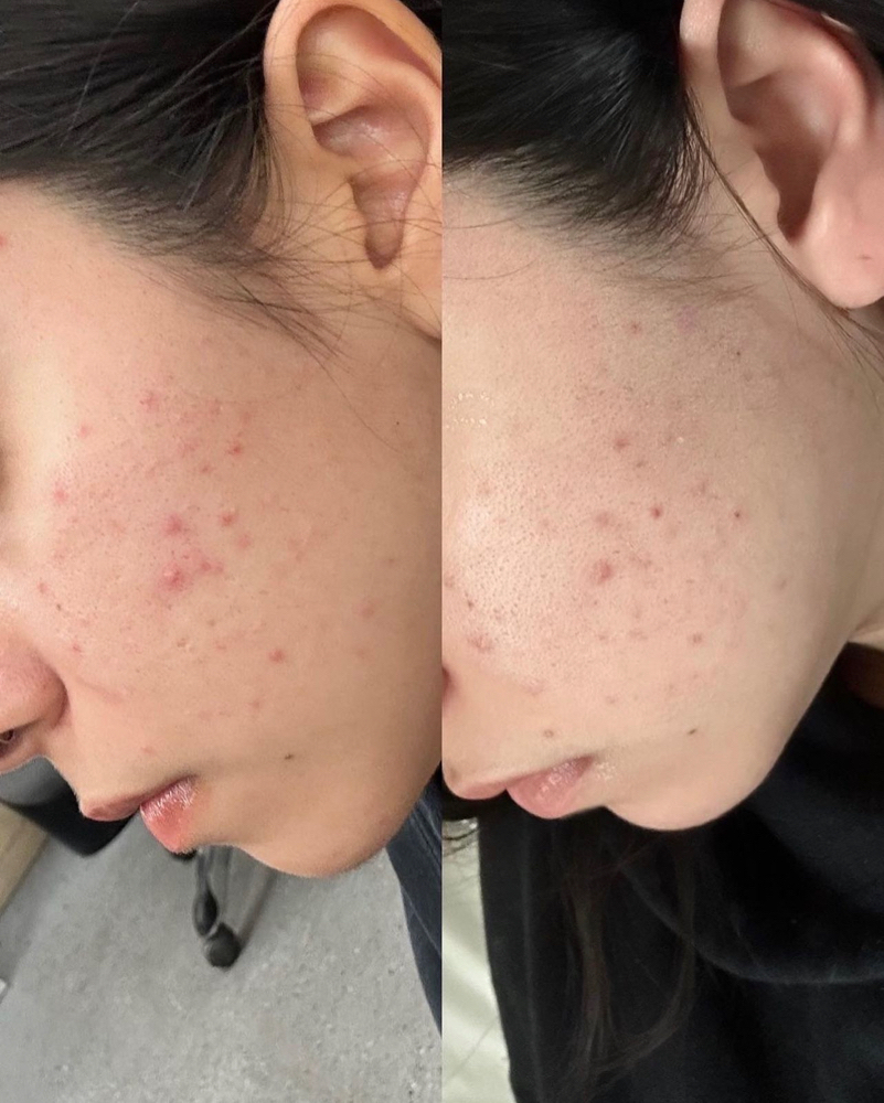 Raspberry Peach Facial