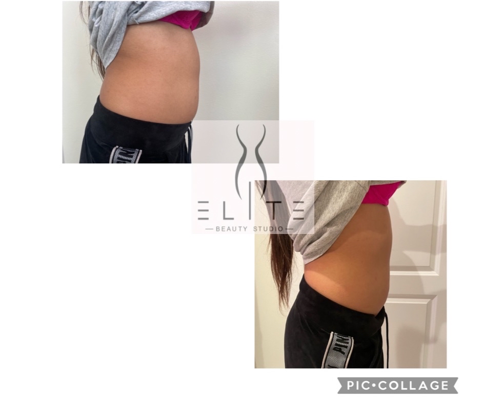 Lipo Laser Single Session
