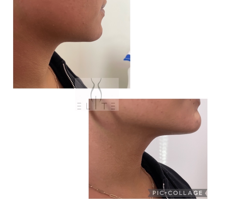 Chin Lipo Laser & RF