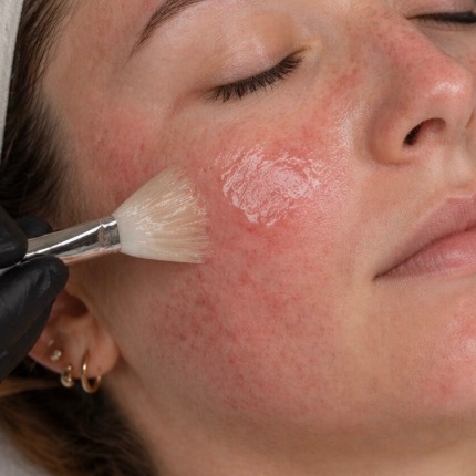 Pro Calm + Restore Treatment at Esthetics x Evelyn in Bakersfield, CA