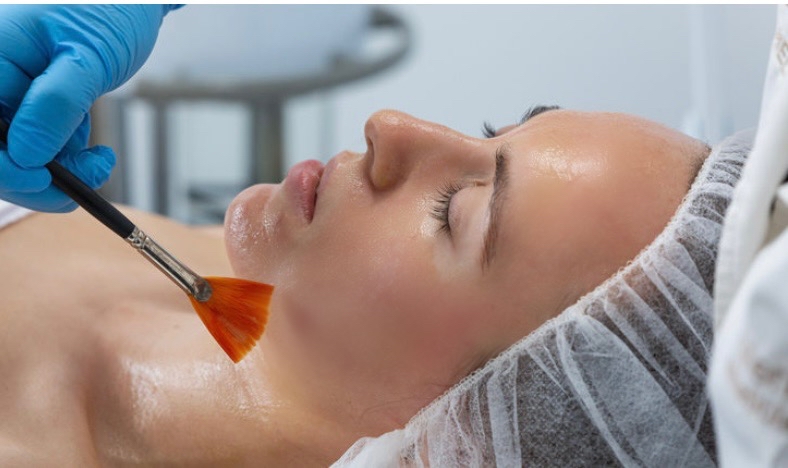 30% Lactic Acid Peel Treatment