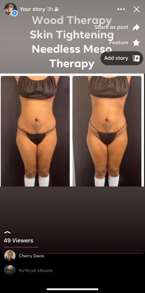 Lipo Shots/Fat Dissolve