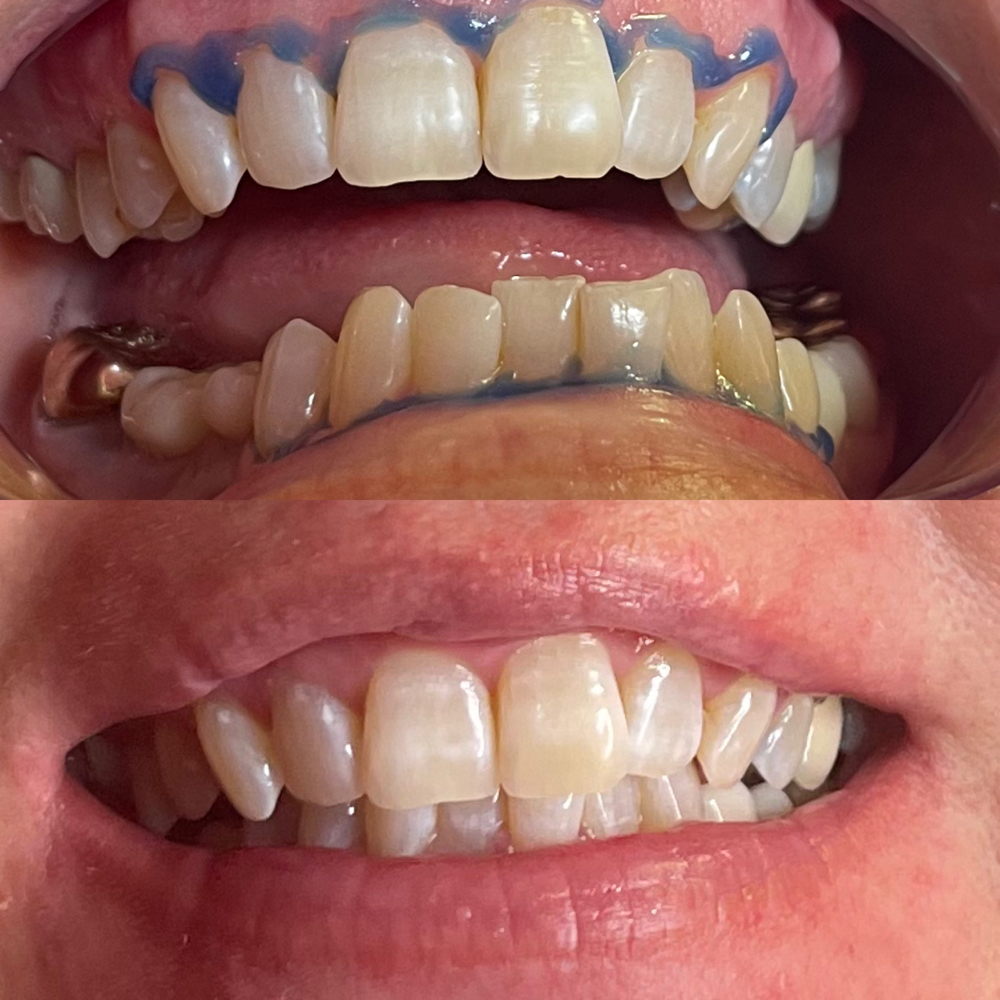 30 Minute Teeth Whitening