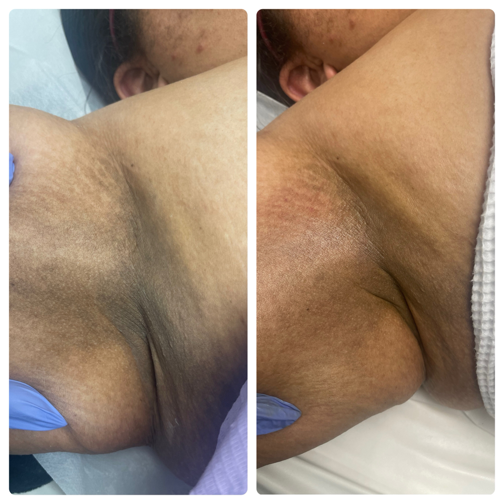 UNDERARM TREATMENT